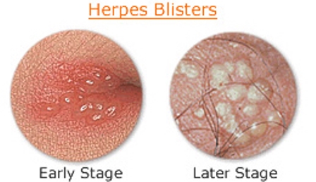 Genital Herpes Blisters – Early Stage – Later Stage