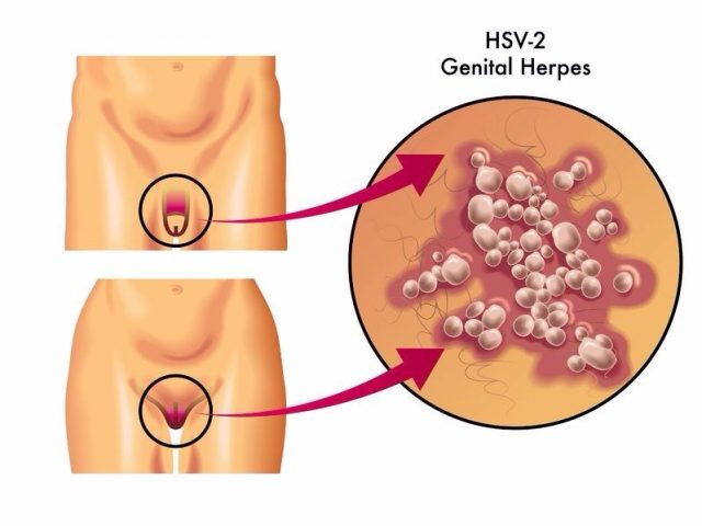 Genital Herpes HSV-2